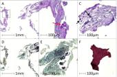 Embolic Protection Snags Debris in Nearly All Lower-Risk TAVI Patients